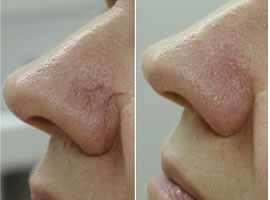Before and after image of facial spider veins in Minneapolis.