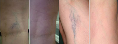 Before and after depiction of treatment for spider veins in MN.