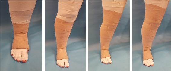 Compression bandages on patient's leg.