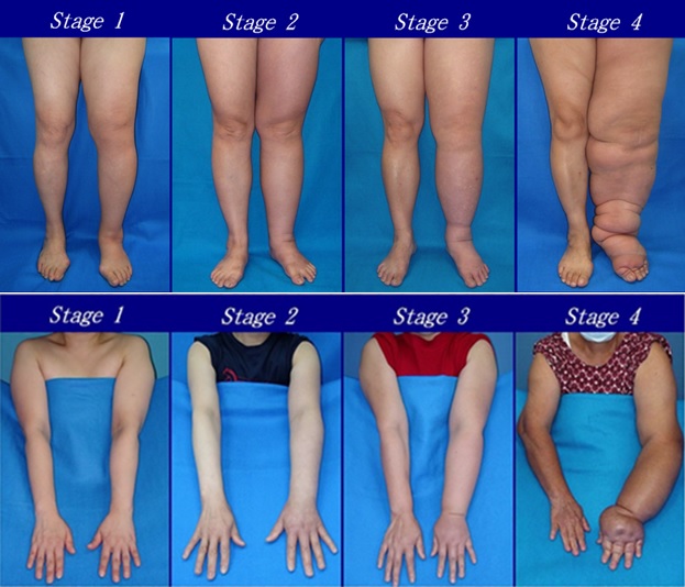 Pictures showing different stages of arm swelling and leg swelling caused by lymphedema.