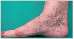Blue Foot / Corona Phlebectasia