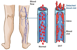 Decreasing Your DVT Risks