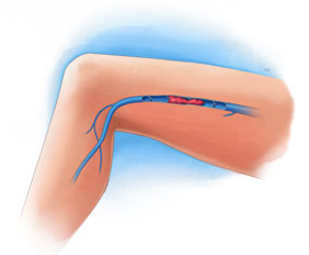 Deep Vein Thrombosis