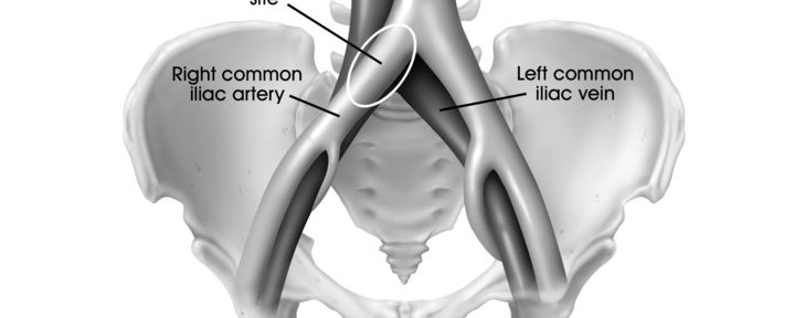 May-Thurner Syndrome