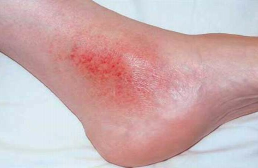 Skin Rash of the Ankle