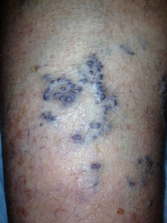 Sudden Bleeding from Varicose Veins
