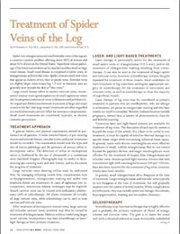 Treatment of Spider Veins of the Leg