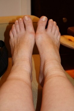 Vein Disease a Cause of Ankle Swelling