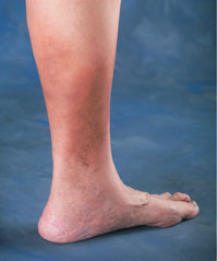 What Causes Brown Spots / Ankles